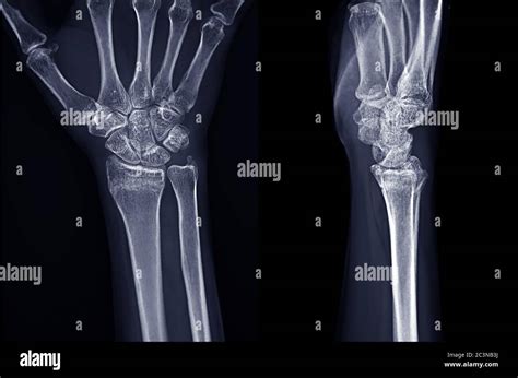 wrist ap view